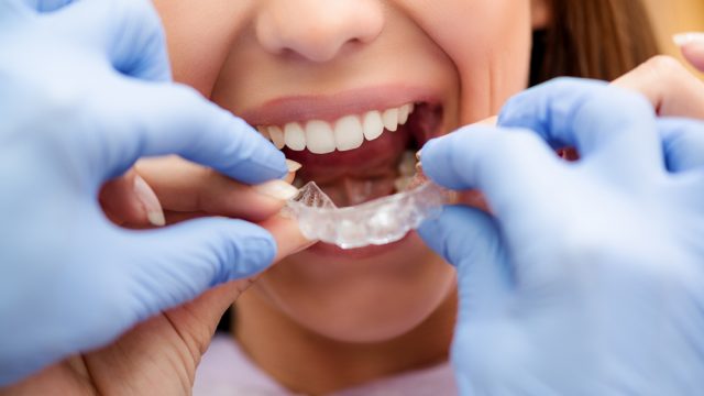歯の矯正のメリット