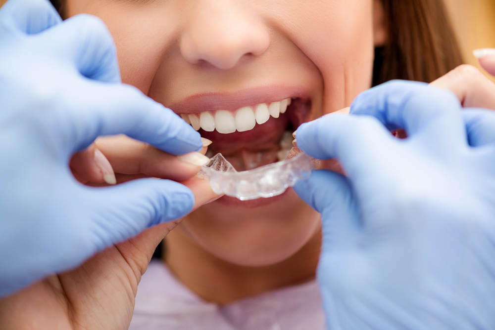 歯の矯正のメリット